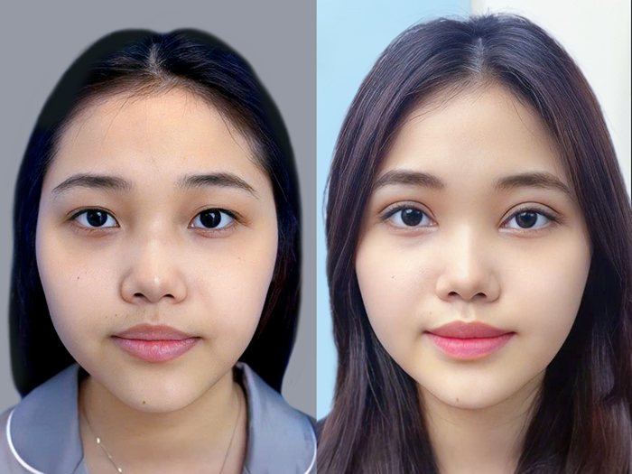 khách hàng sở hữu mí mắt đều đẹp sau phẫu thuật