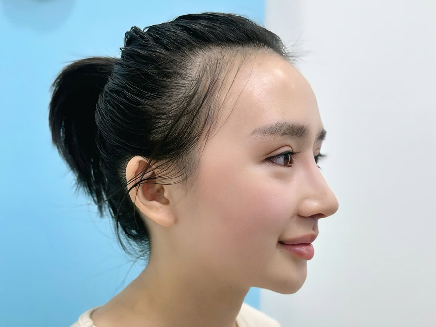 khách hàng sở hữu mũi cao tự nhiên, không lộ vết thẩm mỹ